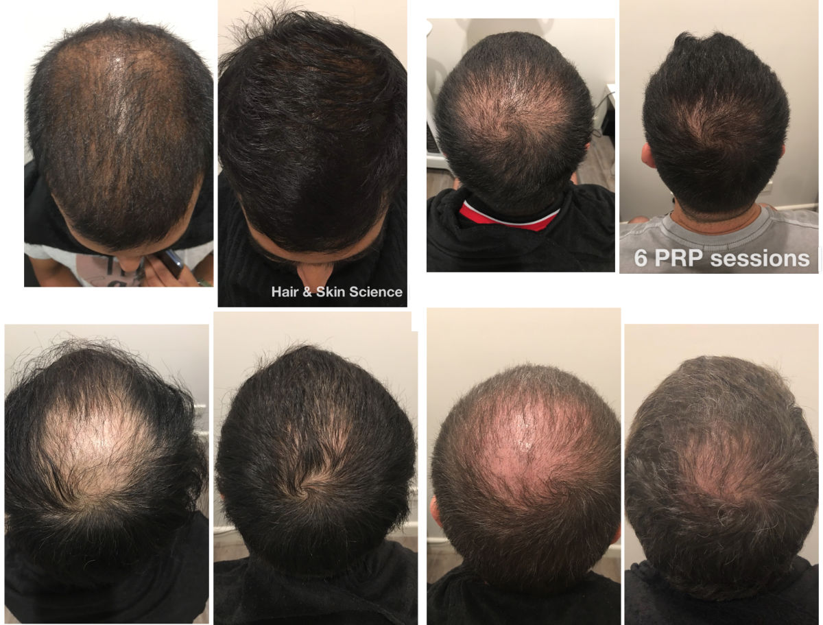 PRP Hair Loss Treatment Sydney, Melbourne & Brisbane
