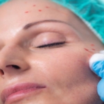 PRP Skin Treatment