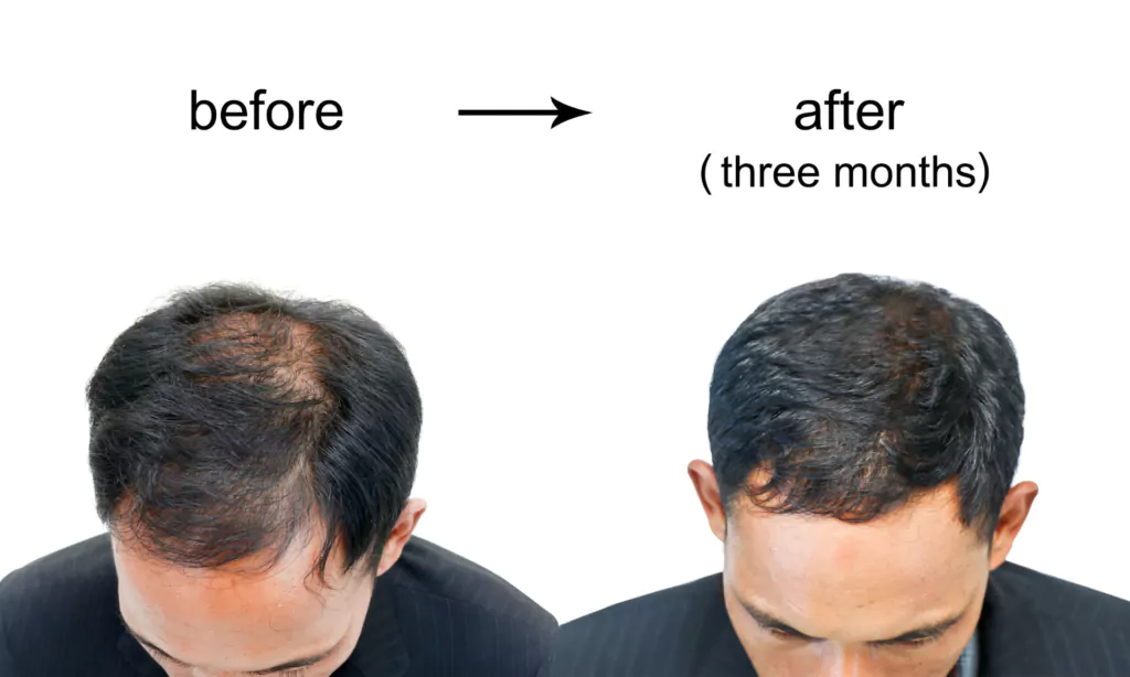 hair loss treatment for men        <h3 class=
